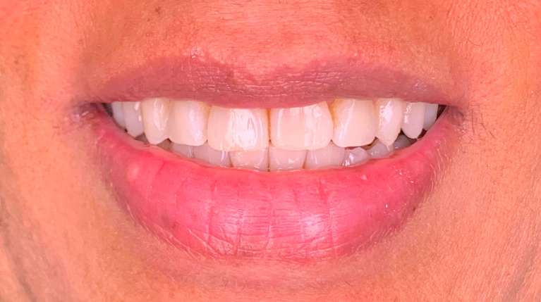 Straighten-Your-Smile-With-6-Month-Invisalign-After-Image