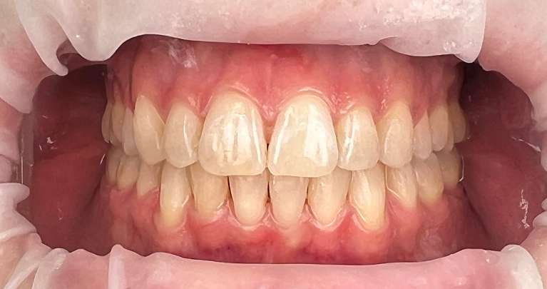 Perfect-Teeth-with-Invisalign-Clear-Braces-After-Image