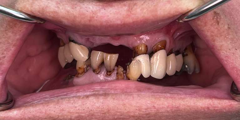 Same-Day-Teeth-Before-Image